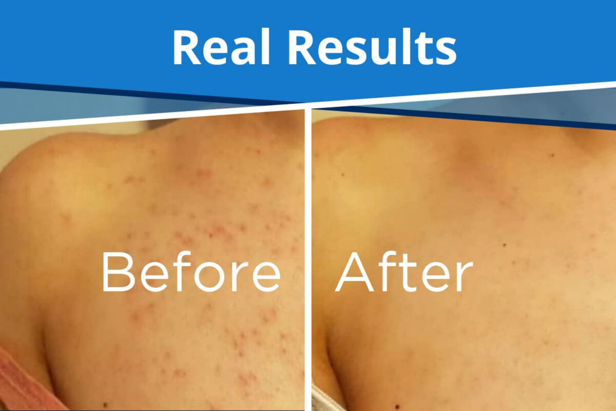 real skin results after skin peel