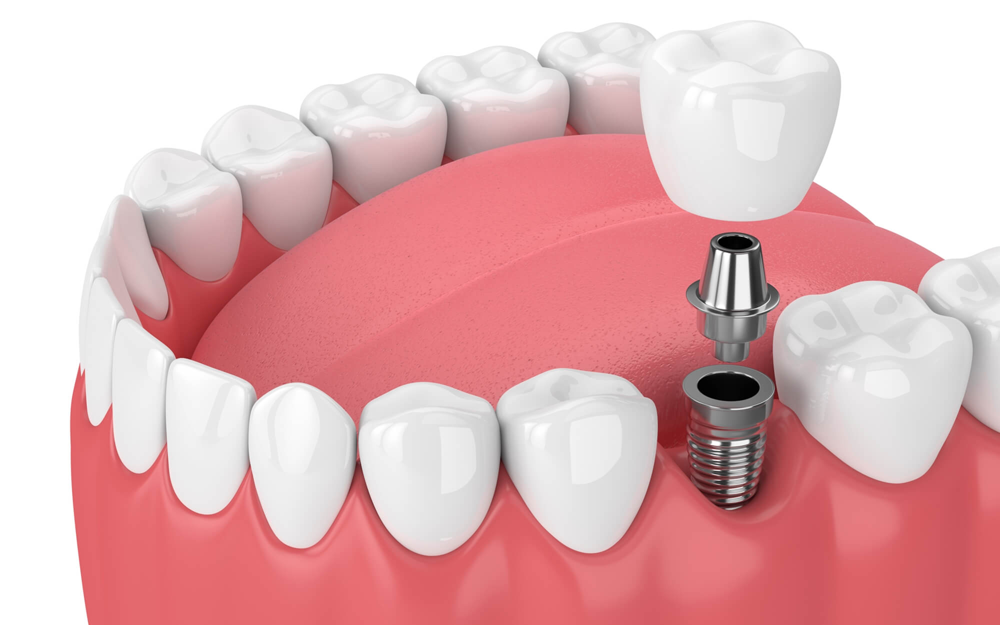 Dental implant mounting