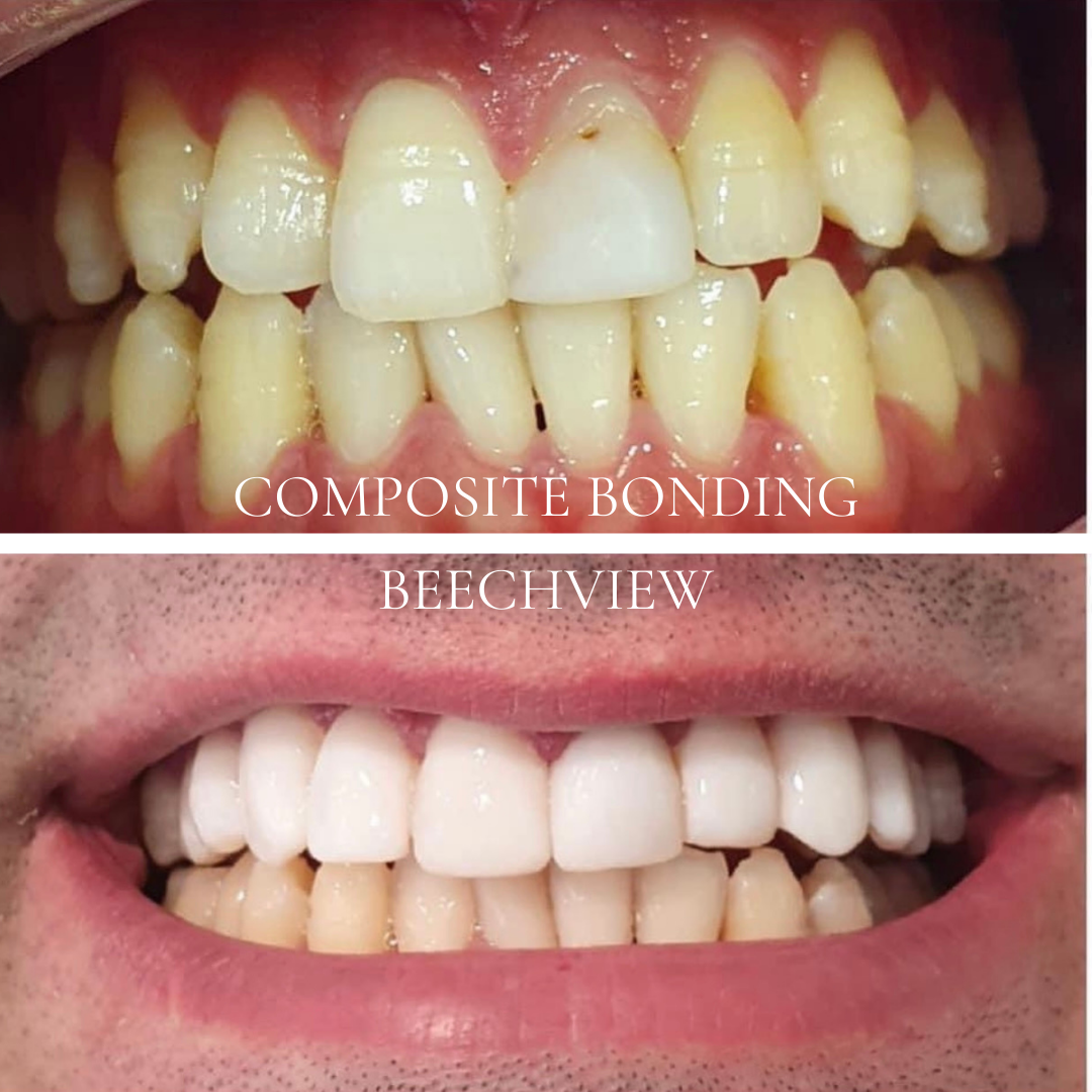 before and after using composite bonding