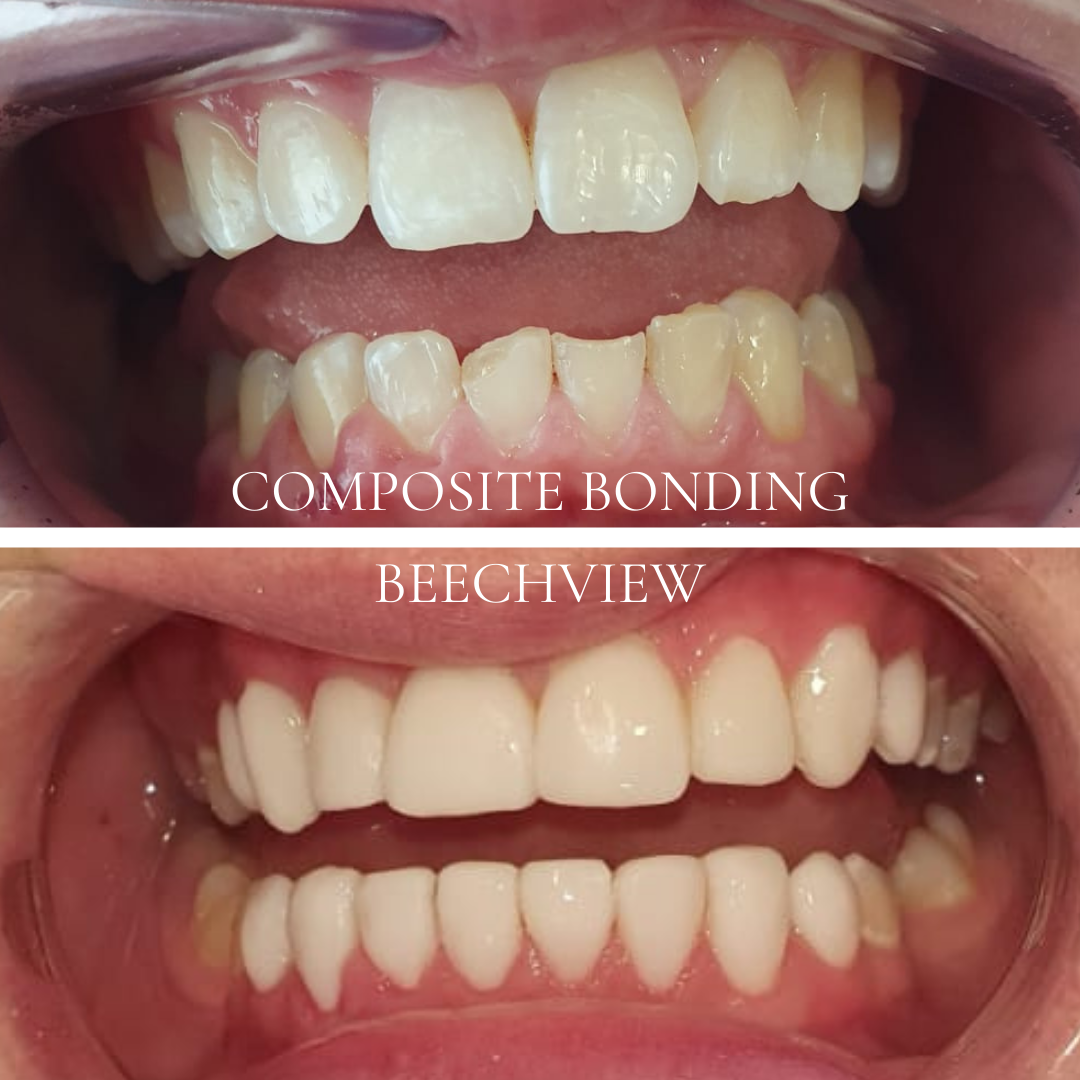 smile transformation using composite bonding