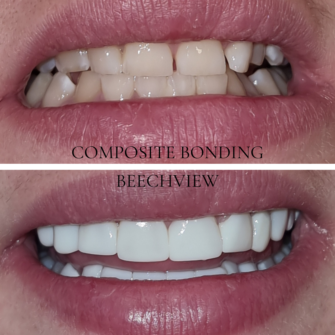 smile transformation of composite bonding