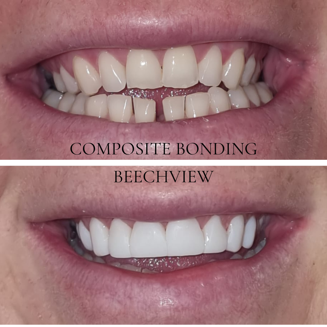 before and after of composite bonding