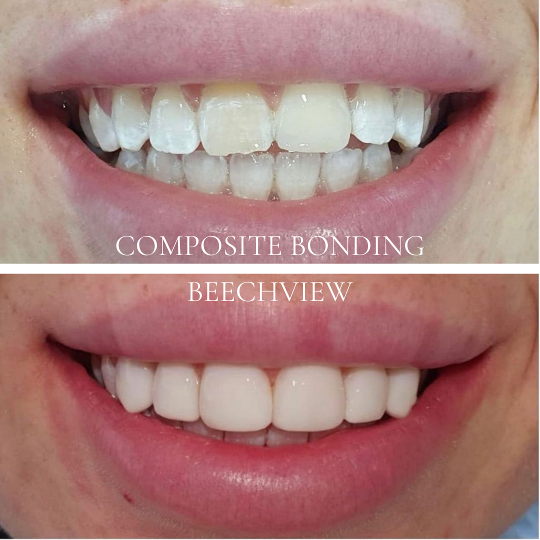 before and after using composite bonding