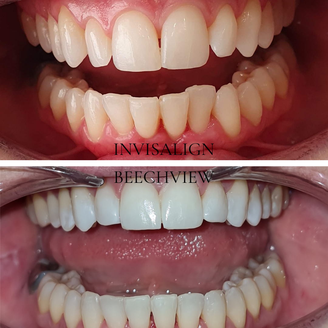 before and after smile transformation using invisalign