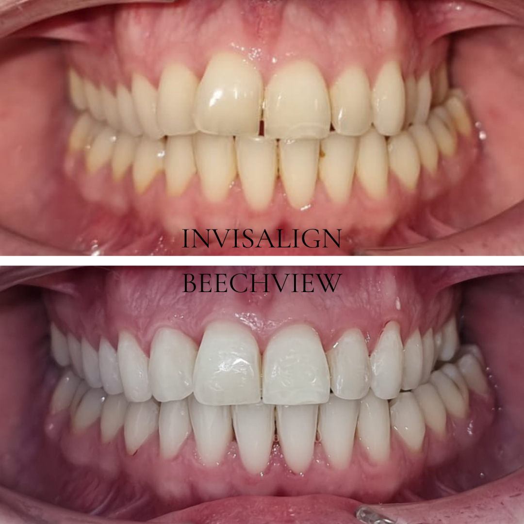 before and after smile transformation using invisalign